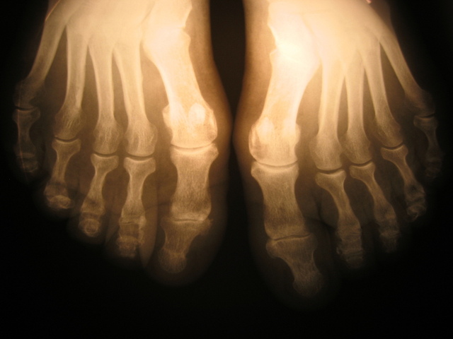 x-ray-foot-1435088-640x480